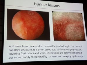 hunner-lesion